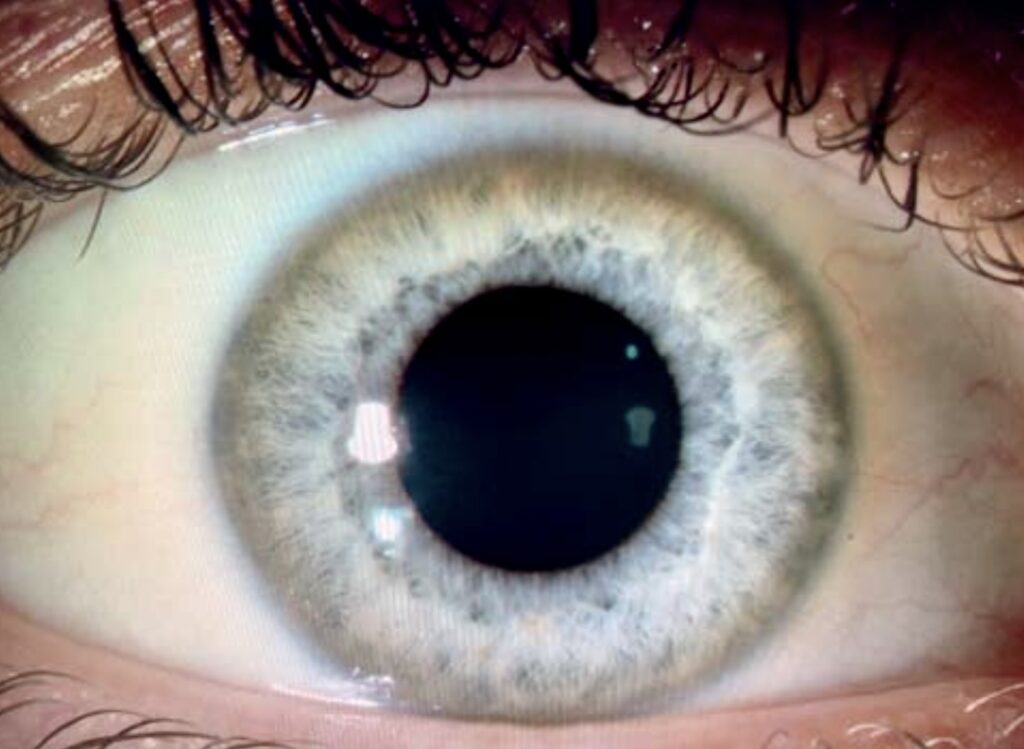 A circular Kayser-Fleischer corneal ring of the Descemet membrane is visible, parallel to the limbus