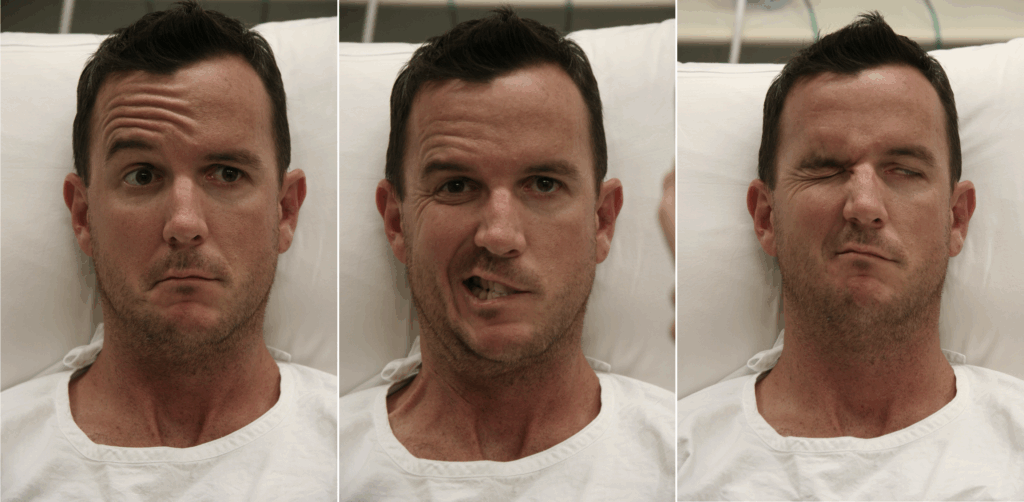 Left Bell's Palsy