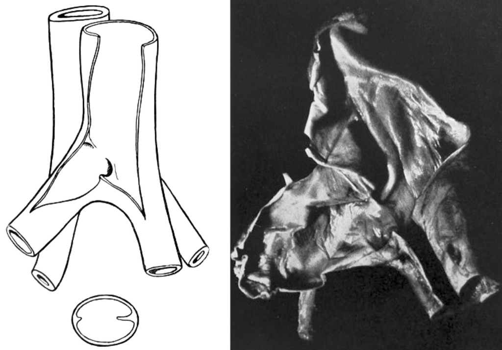 A dorsal view of the opened cava bifurcation May-Thurner
