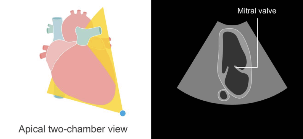 Apical 2-chamber view