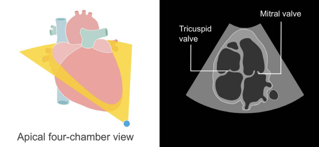 Apical 4-chamber view