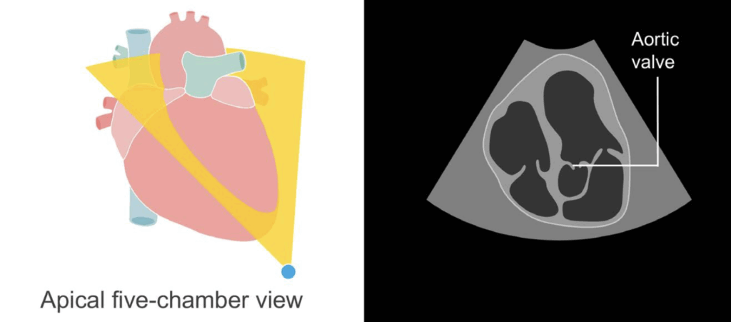 Apical 5-chamber view