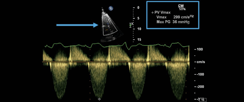 Continuous wave Doppler