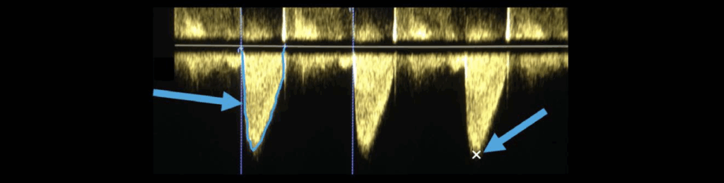 Continuous wave Doppler
