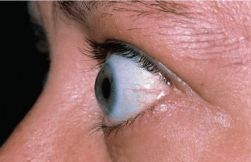 Exophthalmos left eye