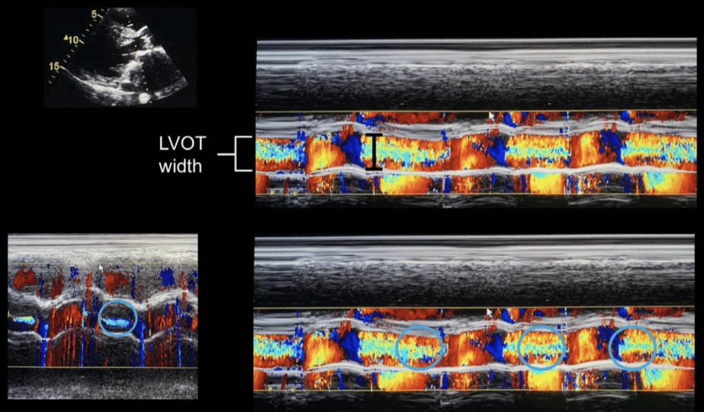 Grading Aortic Regurgitation by Jet Width