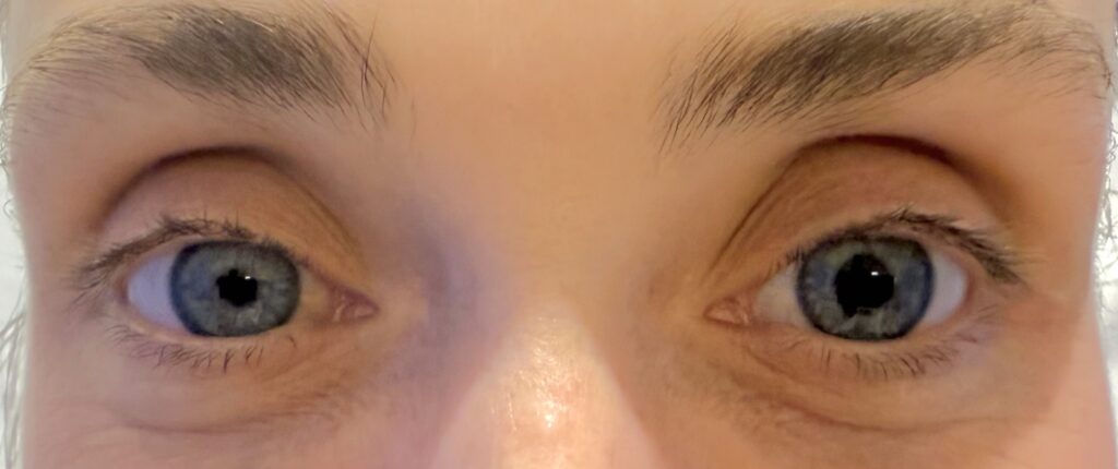 Horner syndrome following Supraclavicular Nerve Block