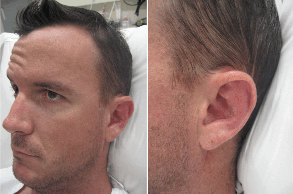 Left Ramsay Hunt syndrome