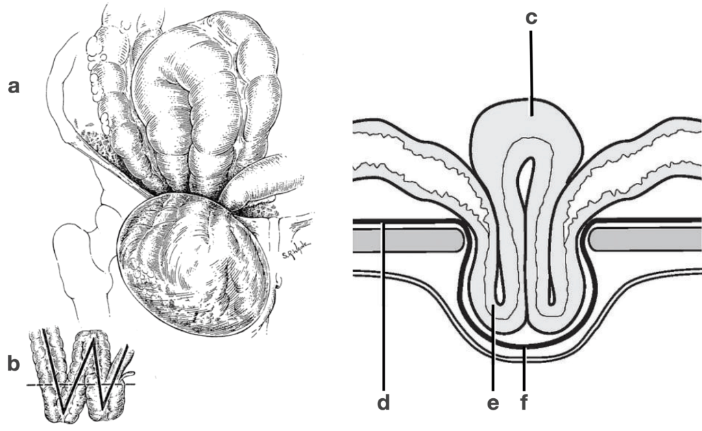 Maydl's hernia (1898)