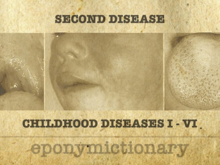 Numbered diseases of childhood SECOND DISEASE 680