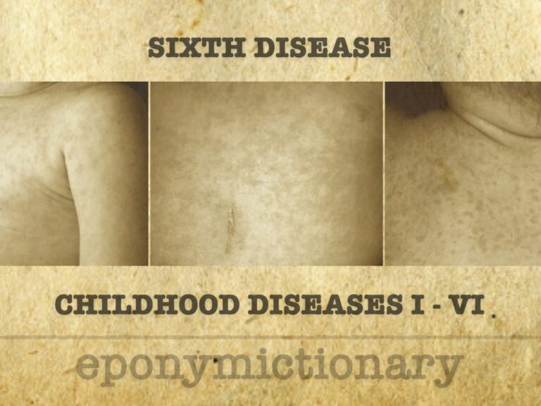 Numbered diseases of childhood SIXTH DISEASE 680