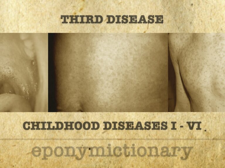 Numbered diseases of childhood THIRD DISEASE 1200