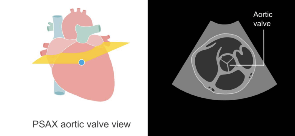 PSAX aortic valve view