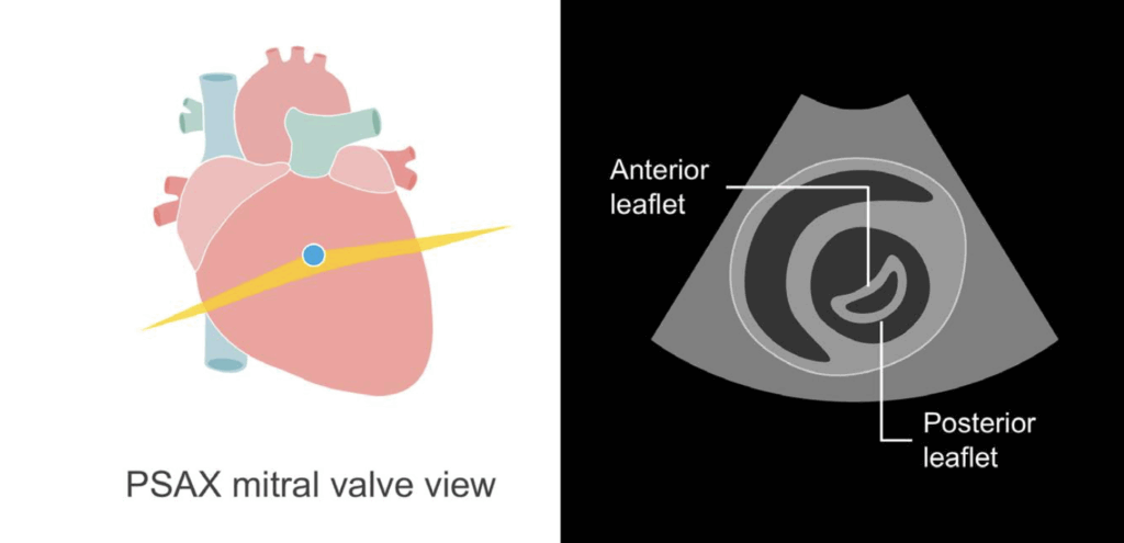PSAX mitral valve view