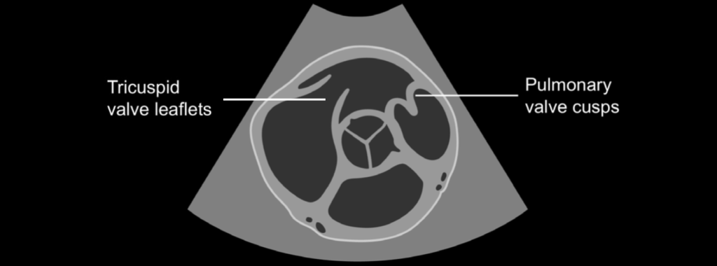 PSAX pulmonary and tricuspid