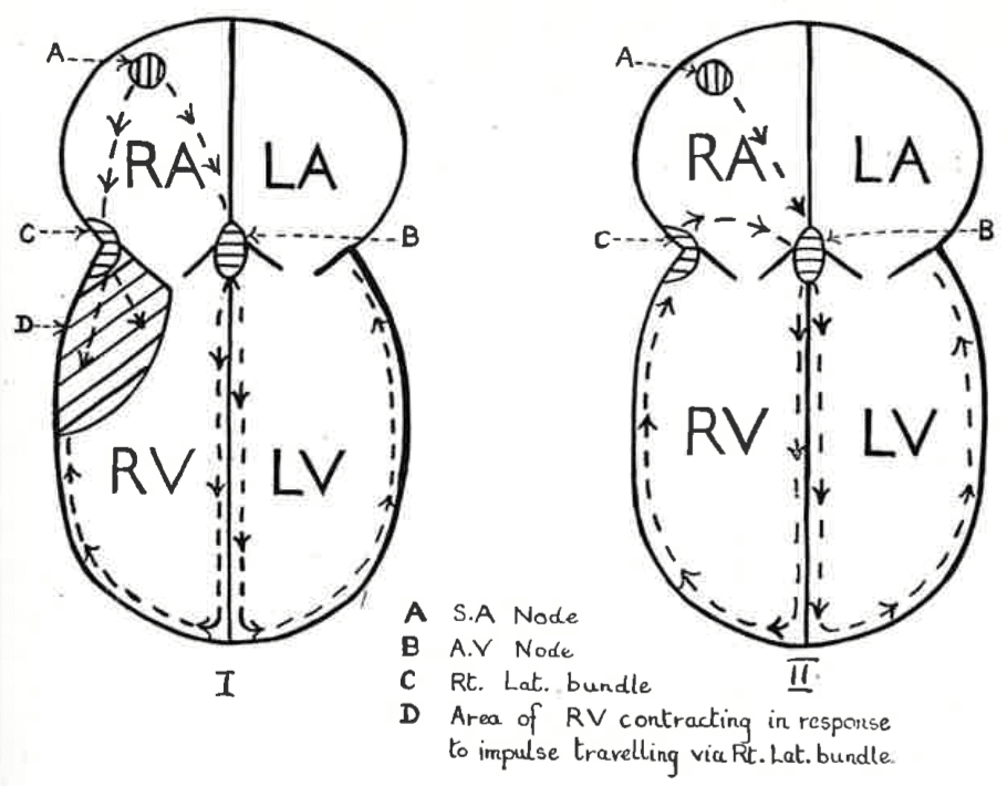 Right Lateral Bundle of Kent 1933