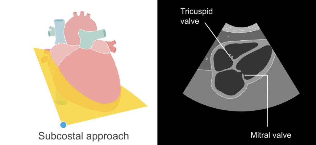 Subcostal approach