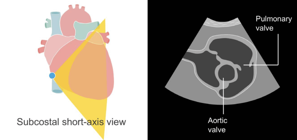 Subcostal short axis