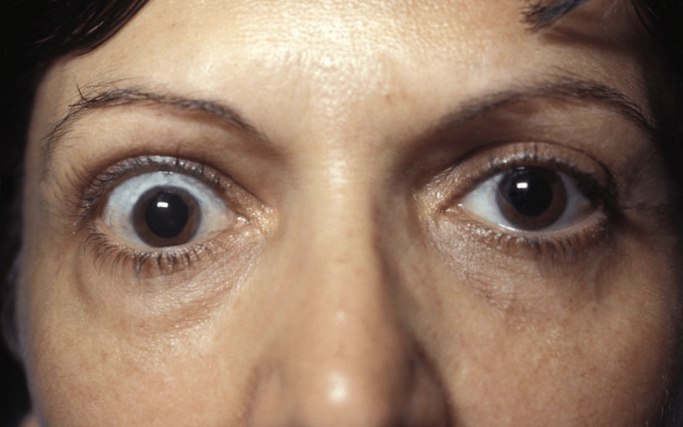 Unilateral exophthalmos