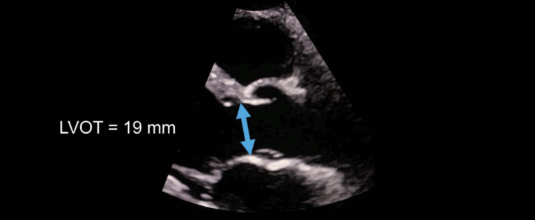 Echo basics: Measurements and Reports • LITFL • Radiology Library