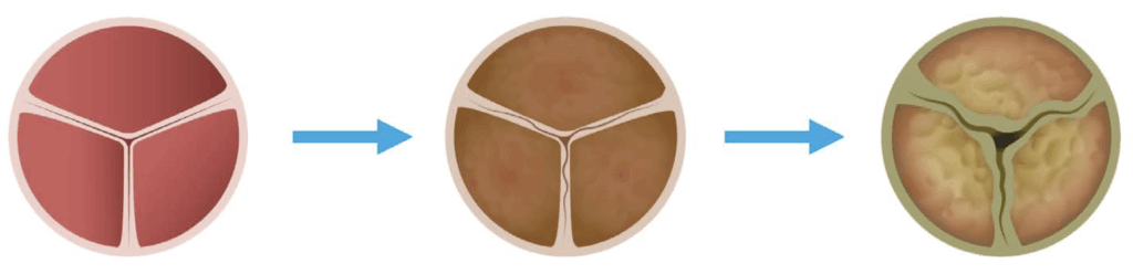 cardiac valve disease