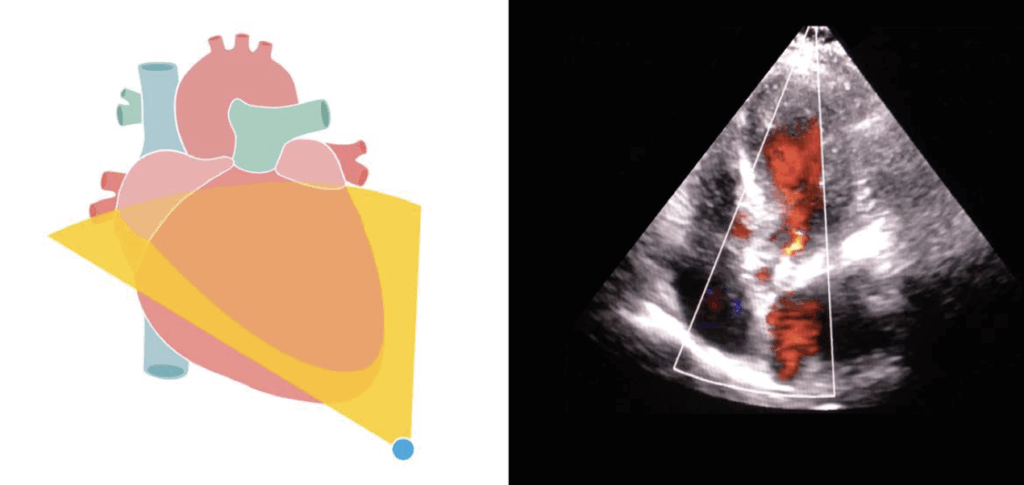 colour Doppler aortic regurgitation