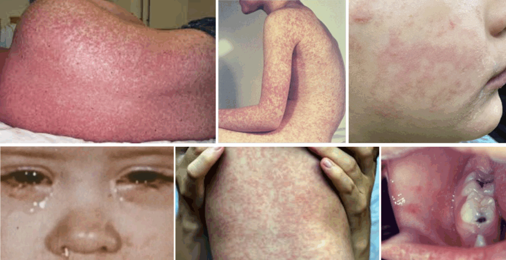 Measles rash, conjunctivitis, Koplik spots
