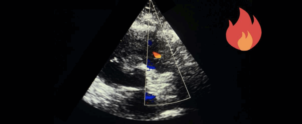 pulmonary regurgitation red flame