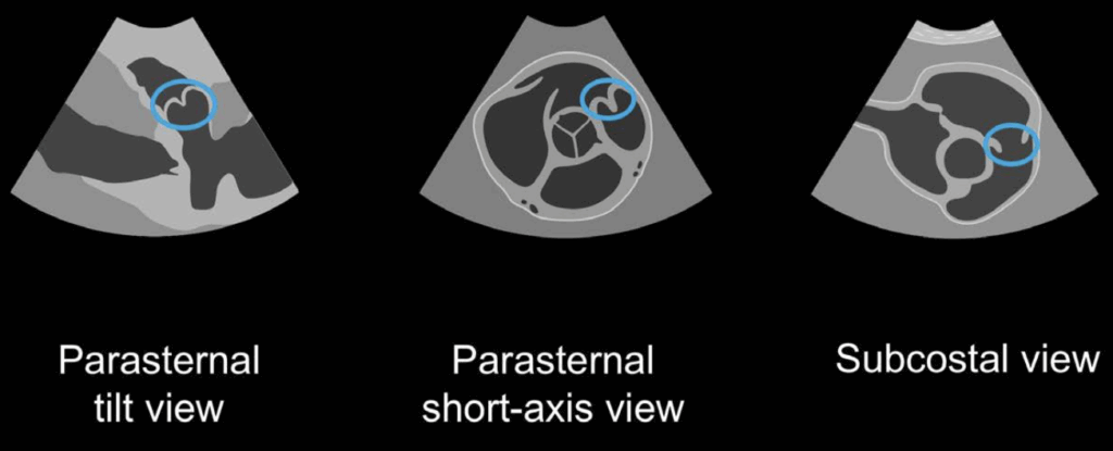pulmonary stenosis echo views