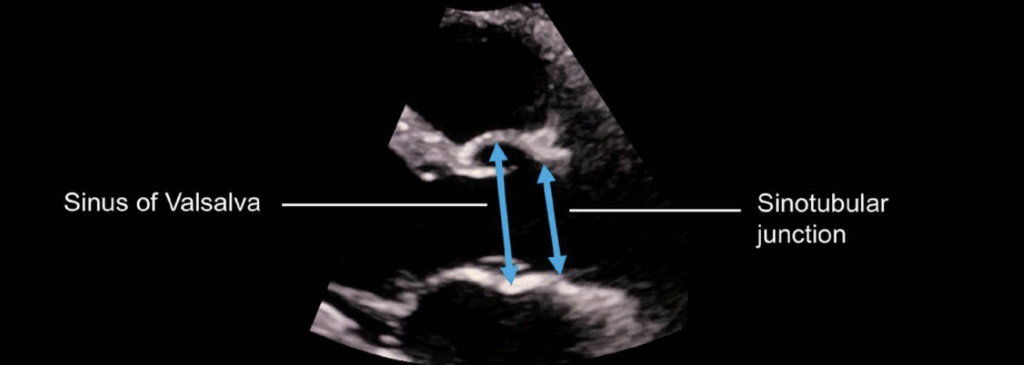 sinus of Valsalva and sinotubular junction diameter