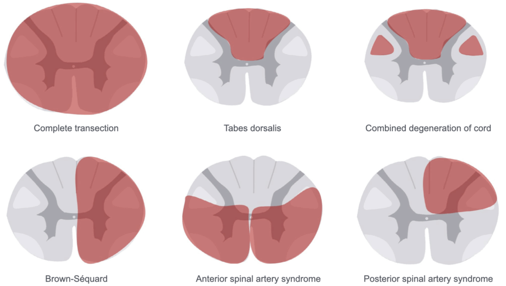 spinal cord lesions