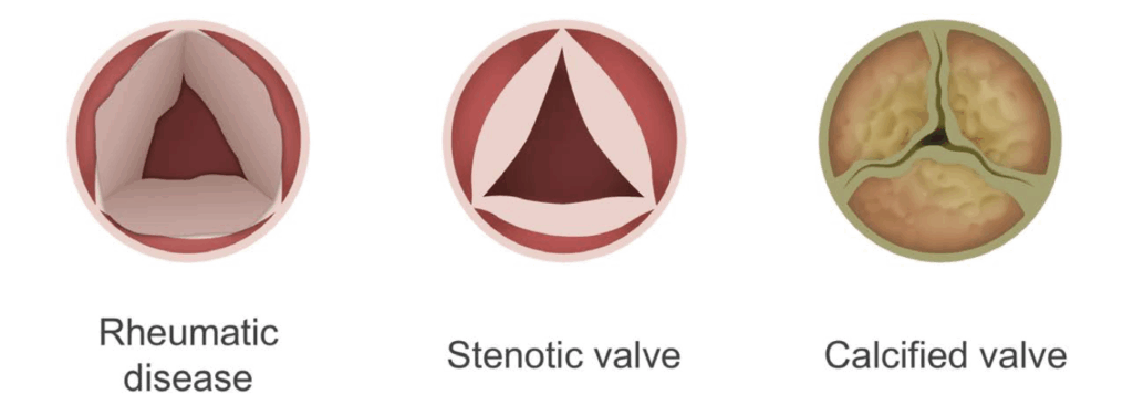 valve stenosis