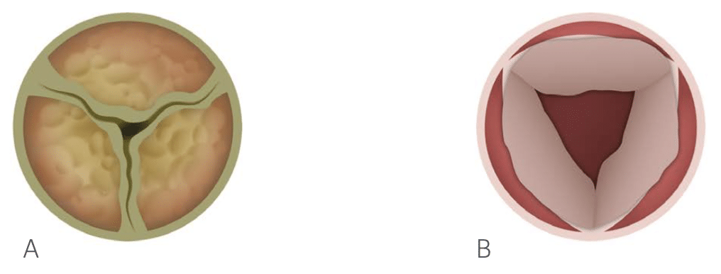Aortic Stenosis aetiology