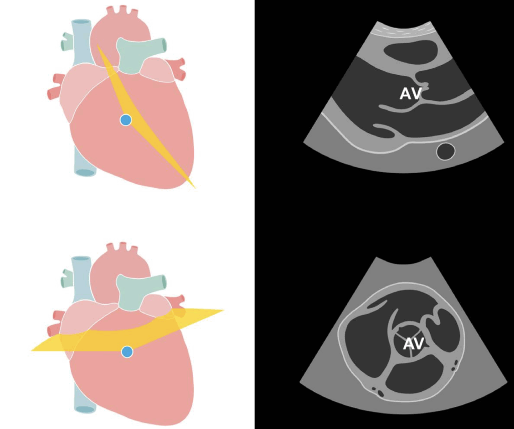 Aortic Valves parasternal and short axis