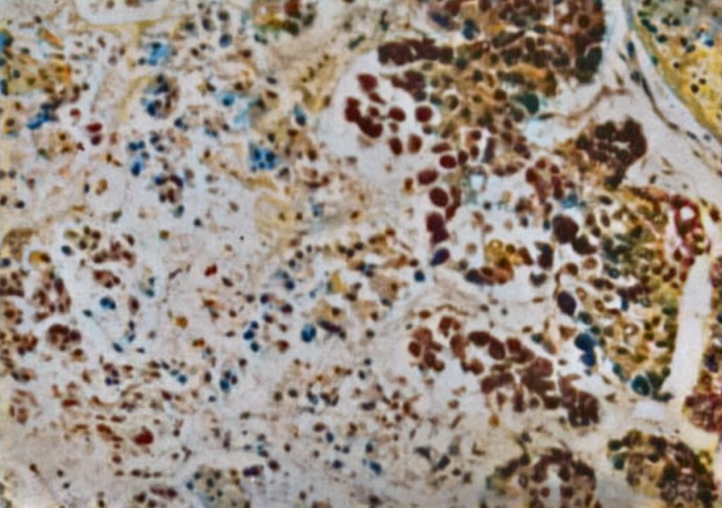 Case 2 - edge of necrosis at 27 hours postpartum Sheehan 1937