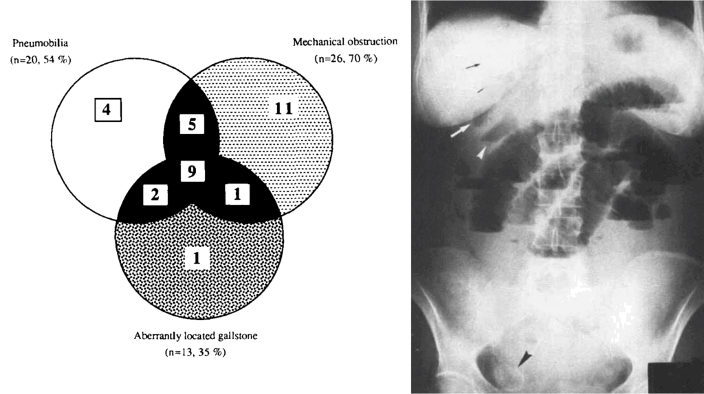 Clavien et al 1990 Gallstone ileus and Riglers triad