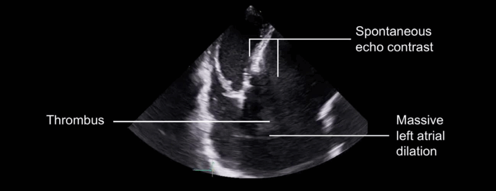 Echo thrombus