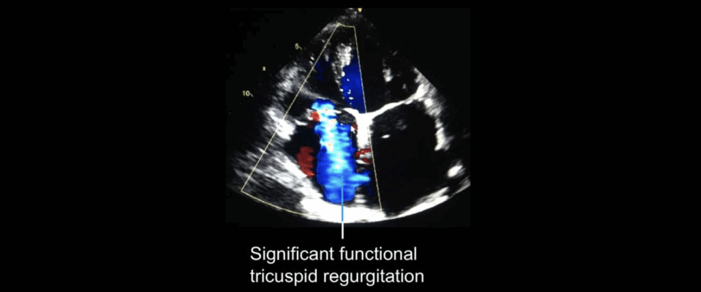 Functional TR