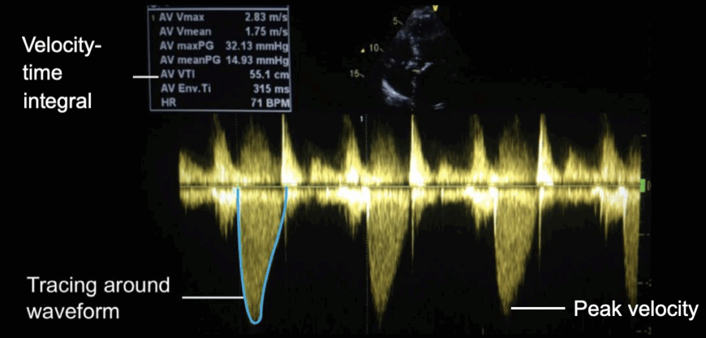Grading aortic stenosis