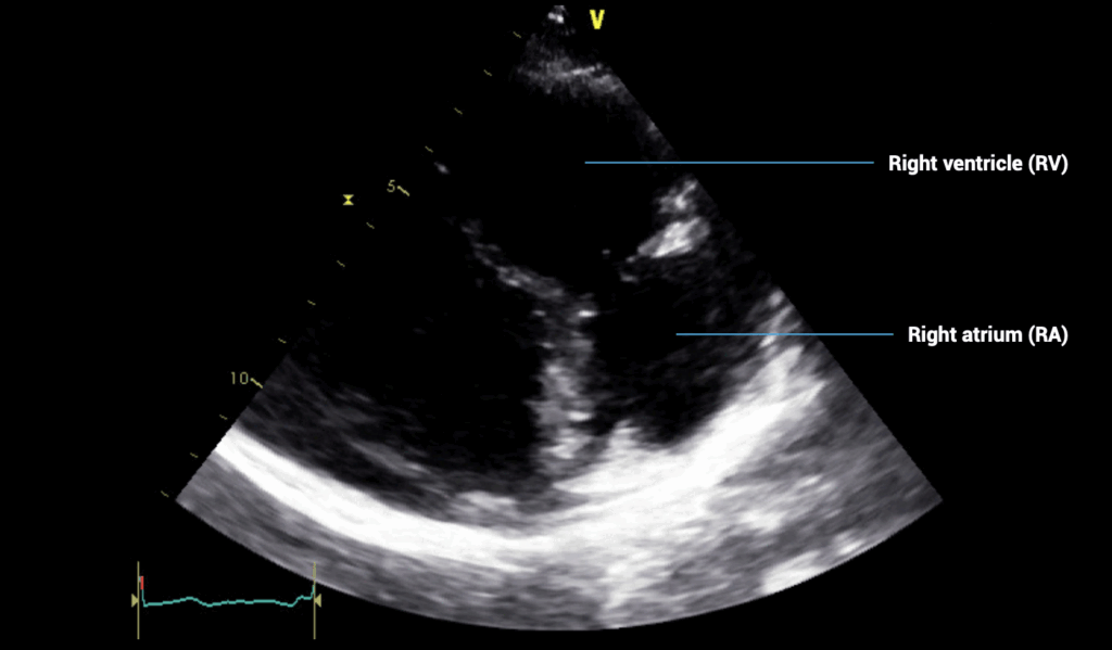PLAX inflow view