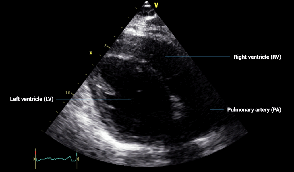 PLAX outflow view