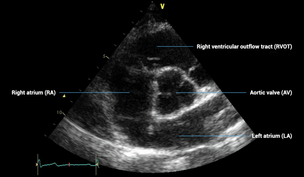PSAX aortic valve view