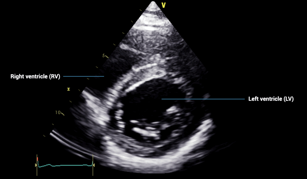 PSAX mitral valve view