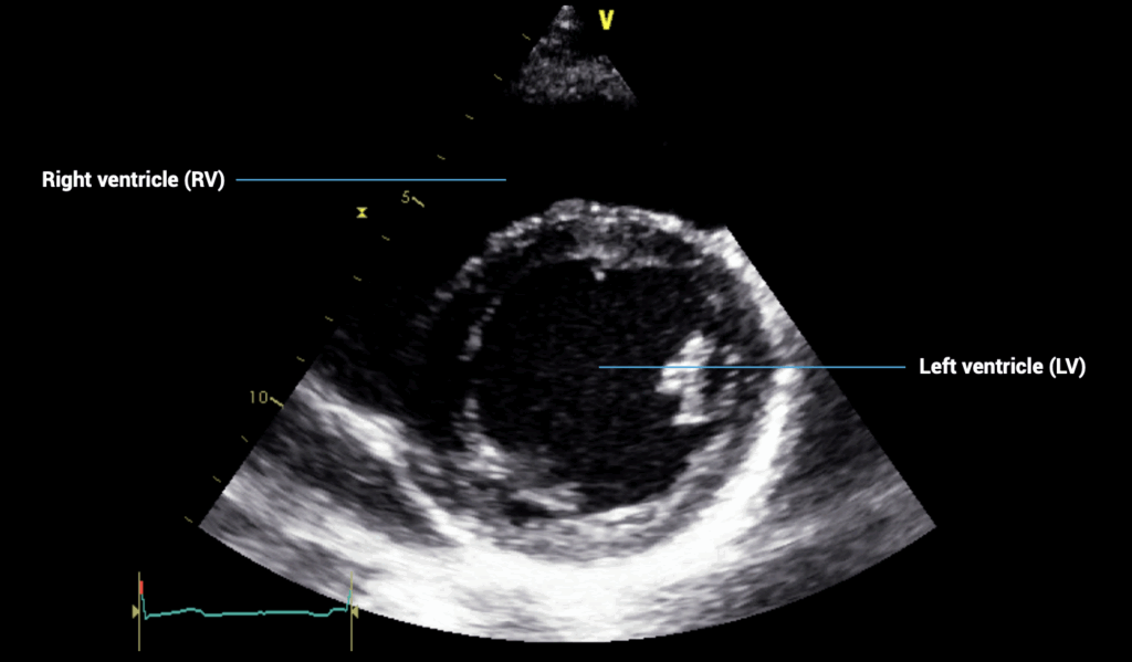 PSAX papillary muscle view