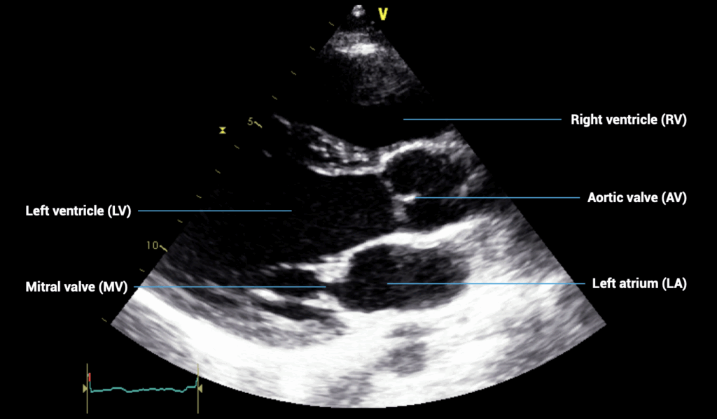 Parasternal optimal image