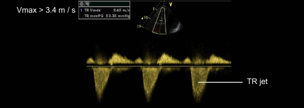 Pulmonary Hypertension MR
