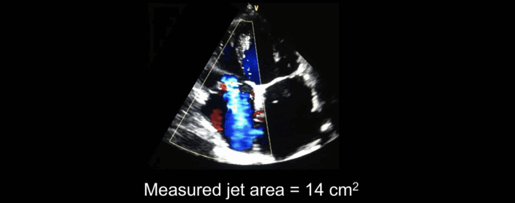 Regurgitant jet area