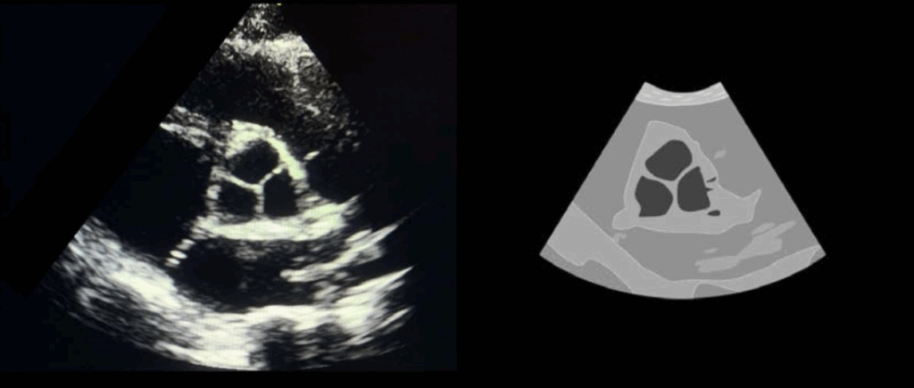 aortic valve short axis