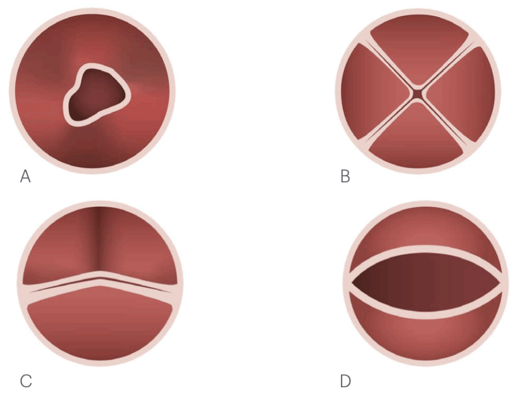 aortic valves in number