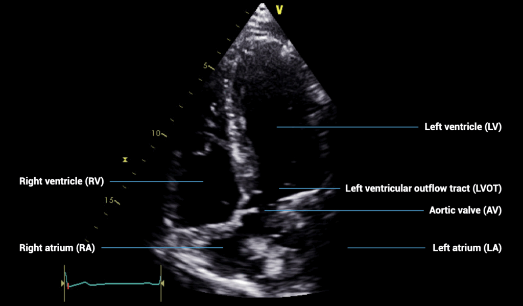 apical five-chamber view